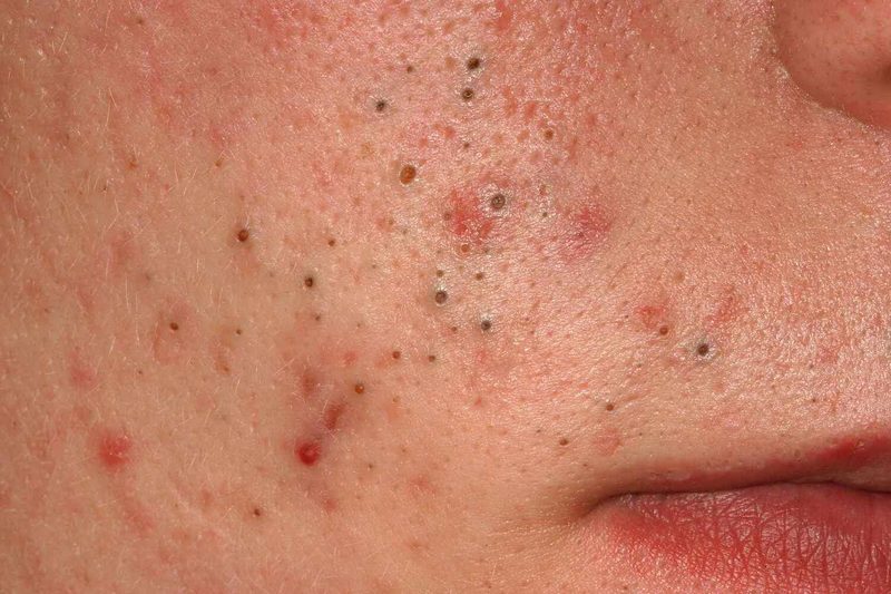Acne Quiz