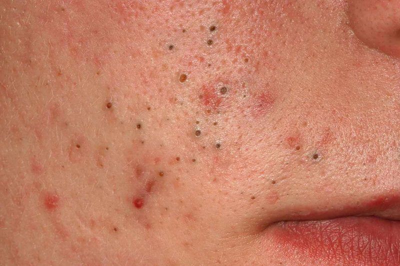 Acne Quiz