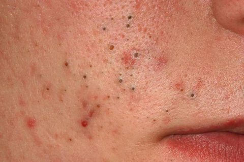 Acne Quiz