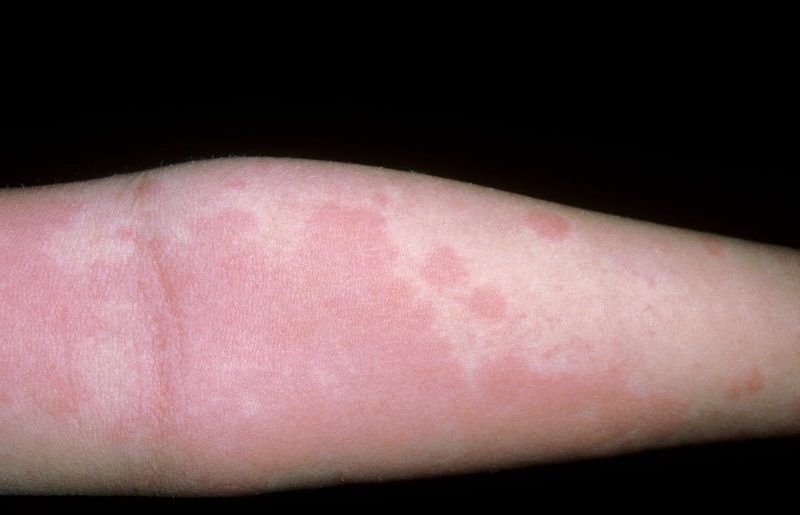 Allergy Quiz