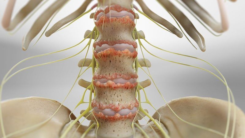 Ankylosing Spondylitis Quiz