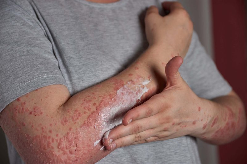Autoimmune Disease Quiz