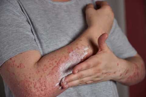 Autoimmune Disease Quiz
