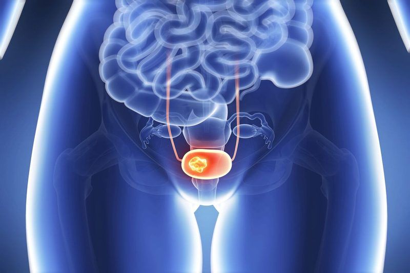 Bladder Cancer Quiz
