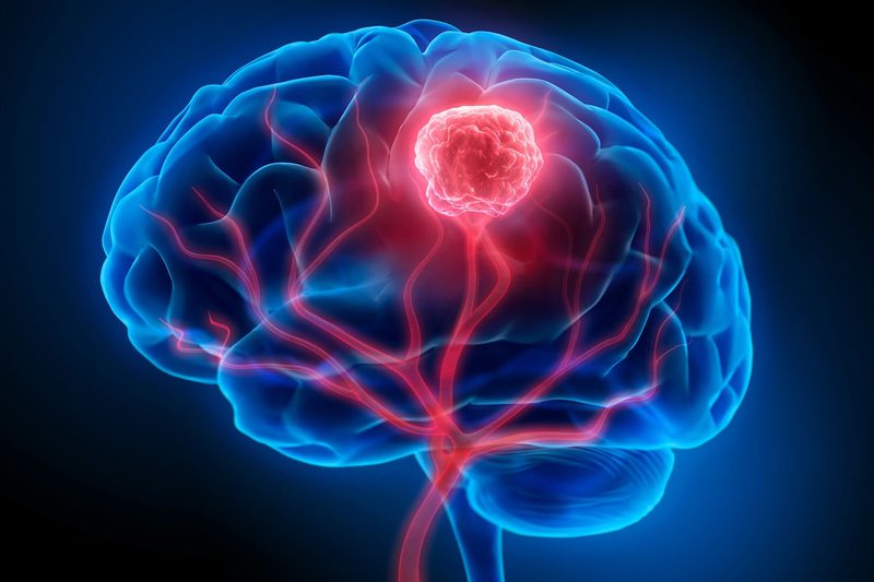 Brain Tumor Quiz