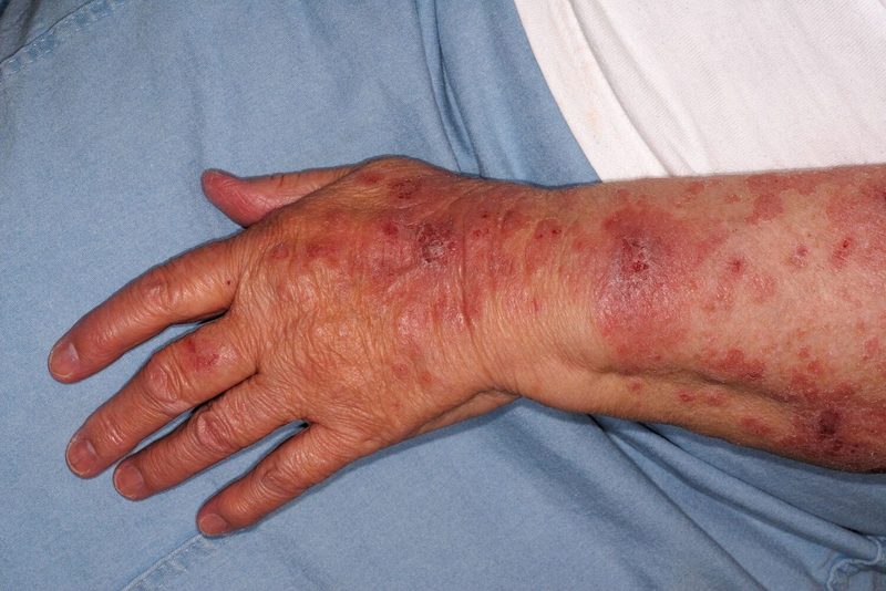 Celiac Disease Quiz