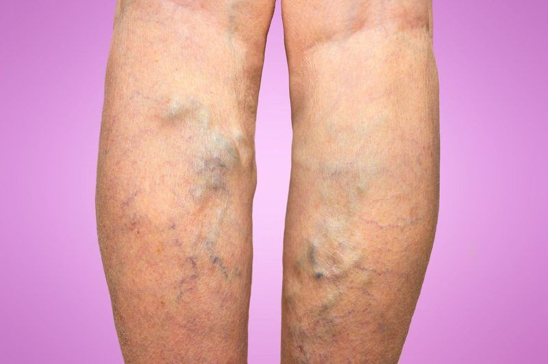 Dvt In My Leg Quiz