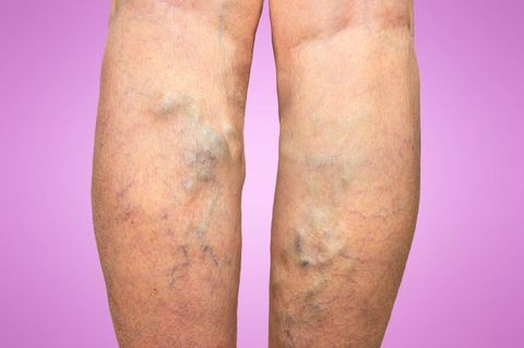 Dvt In My Leg Quiz
