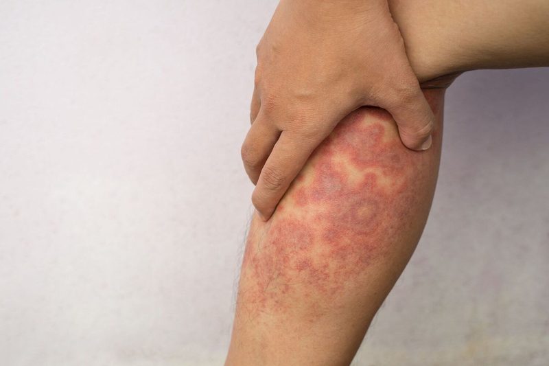 Eczema Quiz