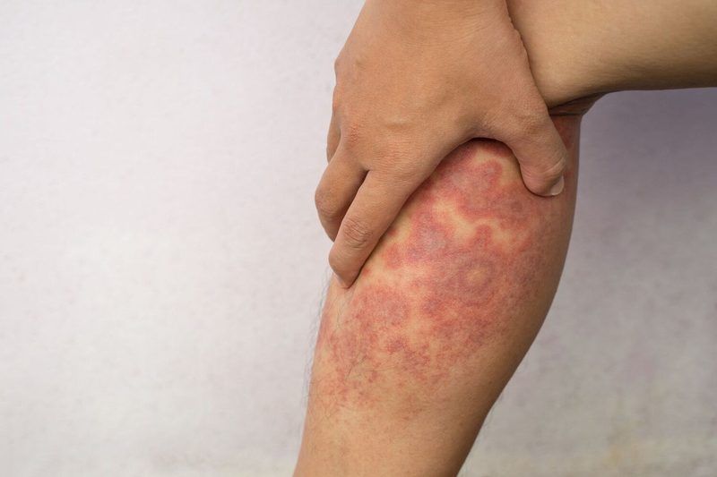 Eczema Quiz