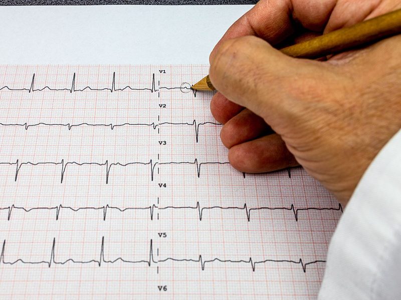 Ekg Practice Quiz