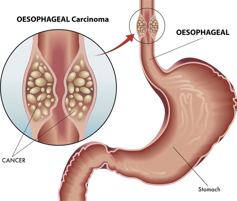 Esophageal Cancer Quiz