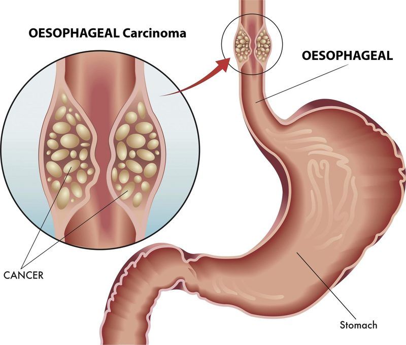 Esophageal Cancer Quiz