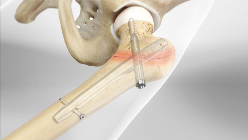 Femur Quiz