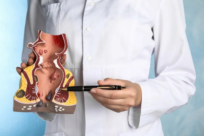 Hemorrhoids Quiz