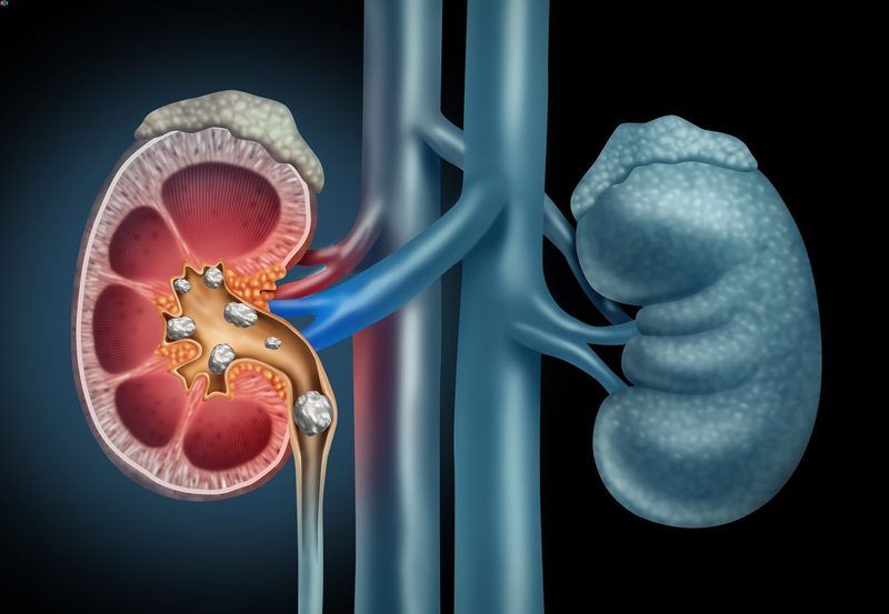Kidney Stones Quiz