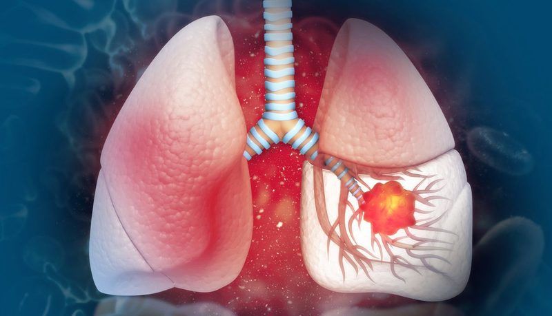Lung Cancer Quiz