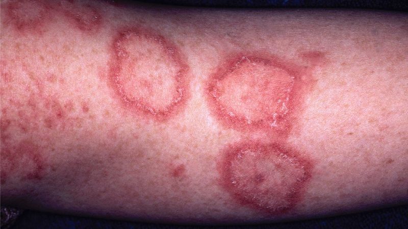 Lupus Quiz