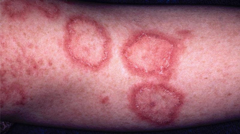 Lupus Quiz