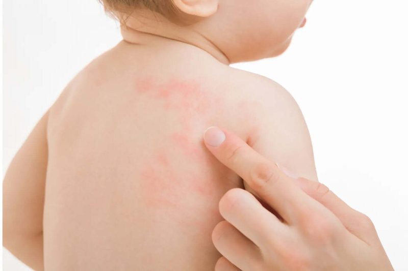 Milk Allergy Quiz