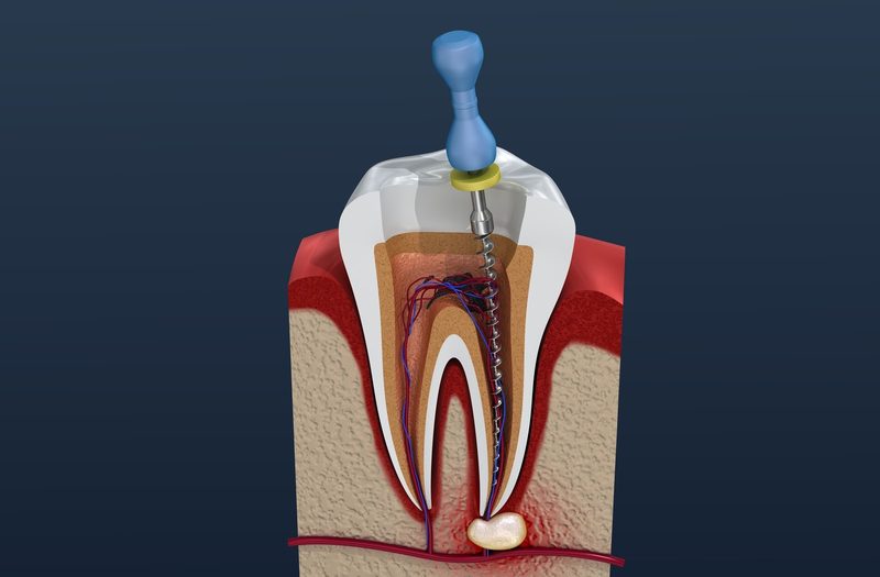 Root Canal Quiz