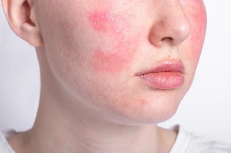 Rosacea Quiz