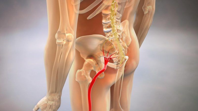 Sciatica Quiz