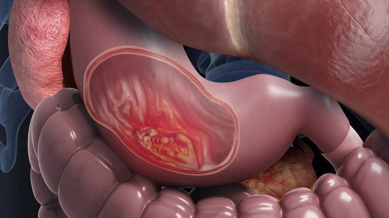 Stomach Cancer Quiz
