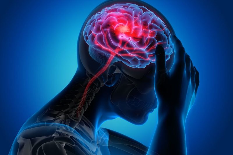 Stroke Quiz