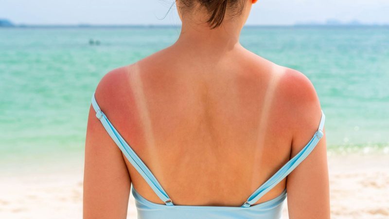 Sunburn Quiz