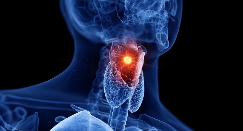 Throat Cancer Quiz