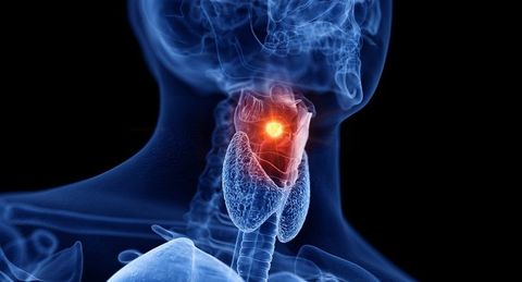 Throat Cancer Quiz