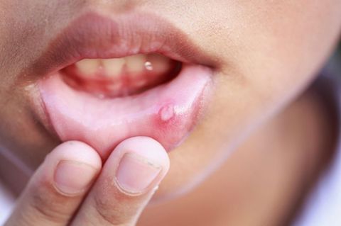 Ulcer Quiz