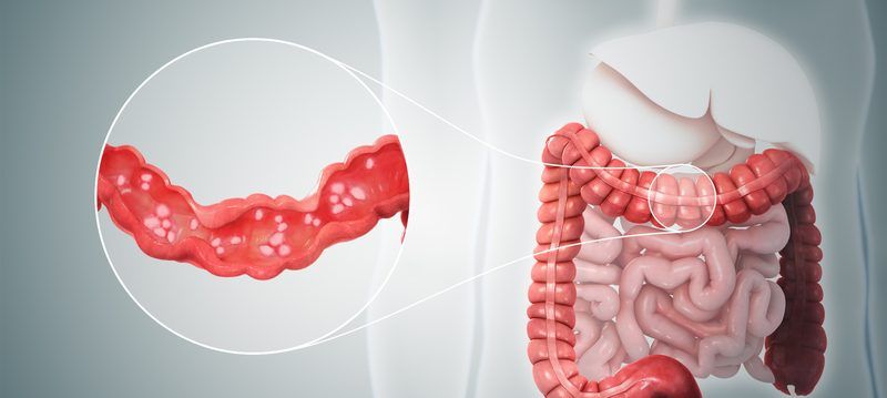 Ulcerative Colitis Quiz