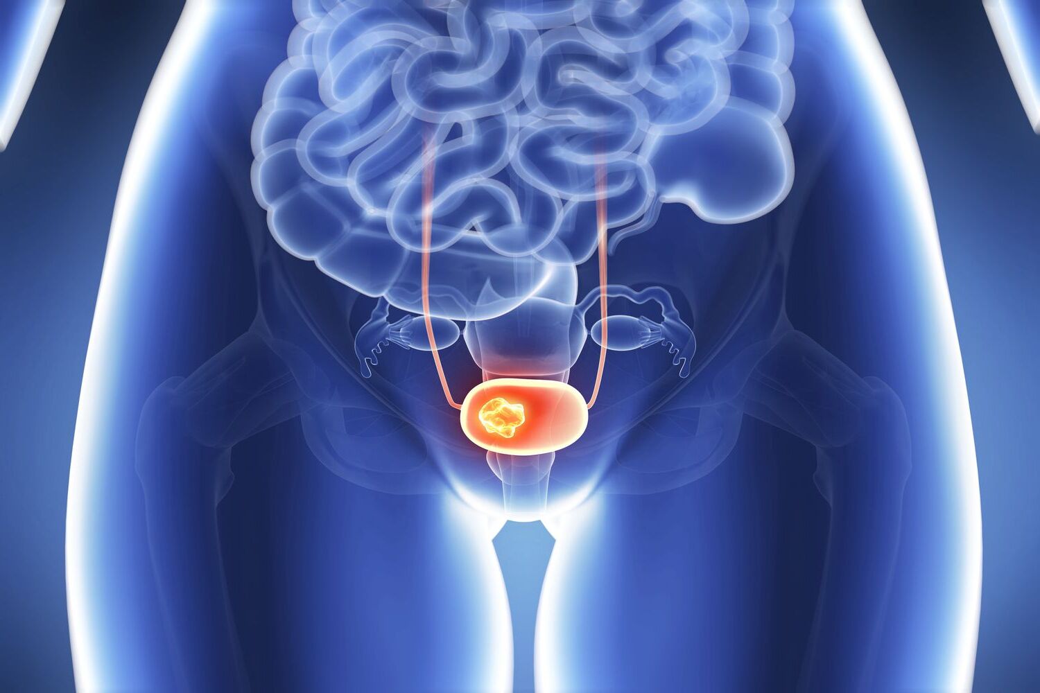 bladder-cancer-quiz