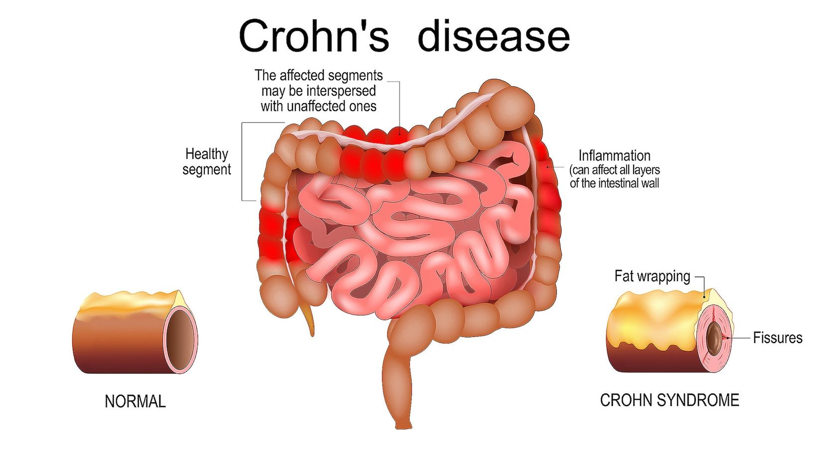 crohns-disease-quiz