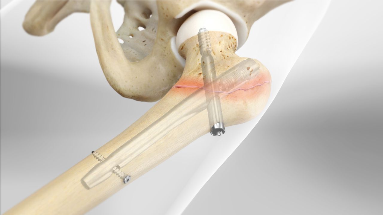 femur-quiz