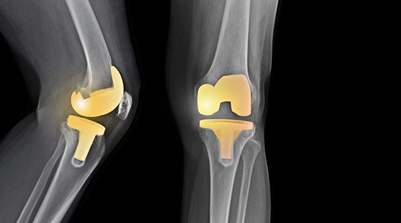 postoperative-knee-arthroplasty-quiz